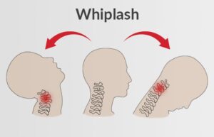 5 Best Exercises To Treat Whiplash At Home