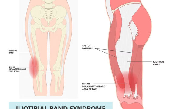 Iliotibial Band Syndrome ITBS