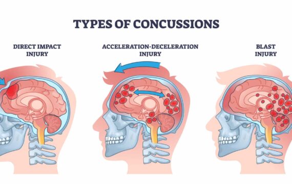 Concussion and head trauma or injury types from medical view outline diagram