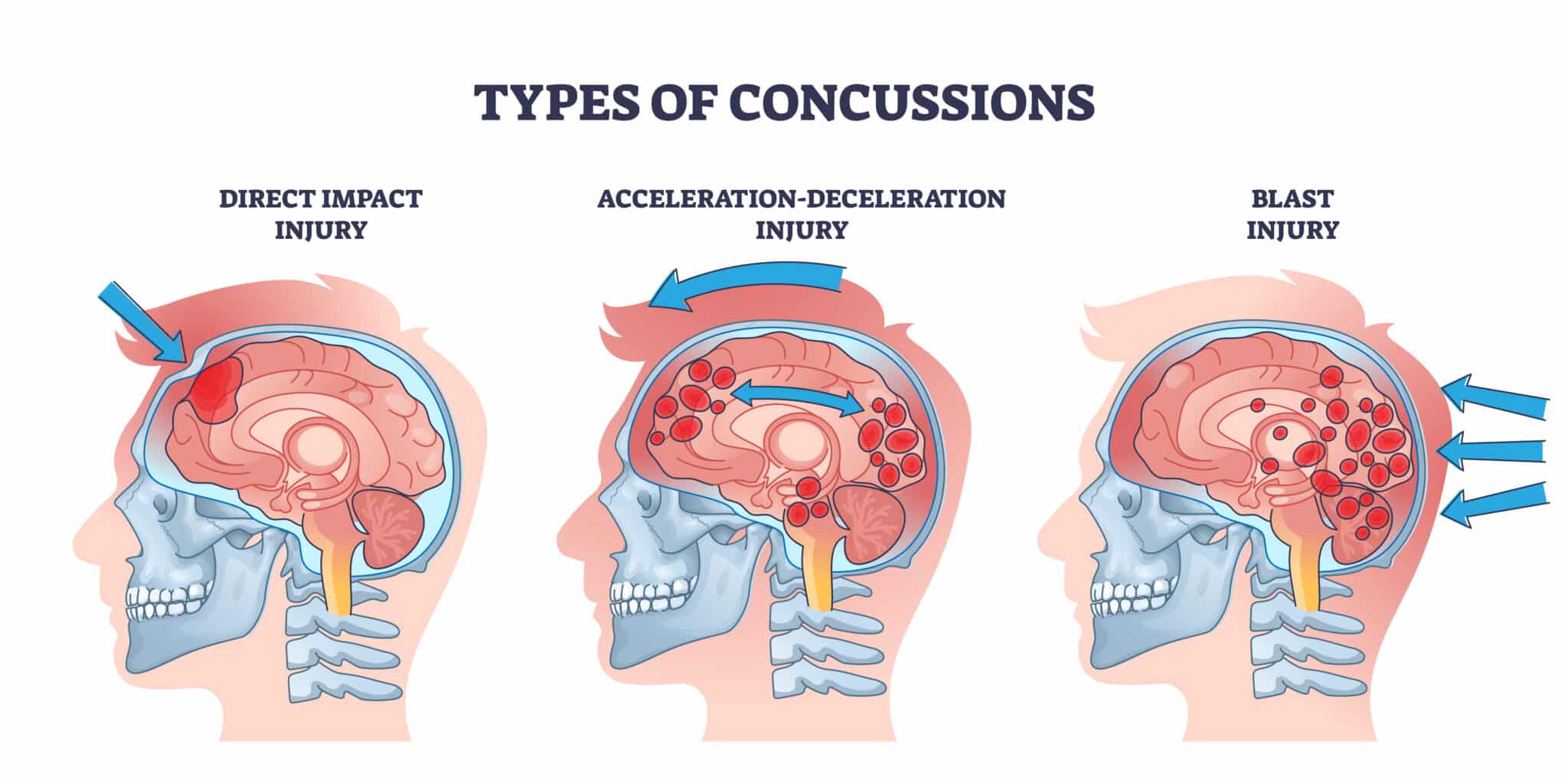 Concussion and head trauma or injury types from medical view outline diagram