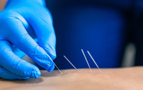 Houston Dry Needling