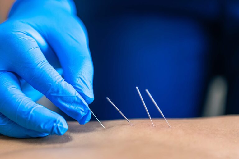 How Houston Dry Needling Helps Persistent Pain?