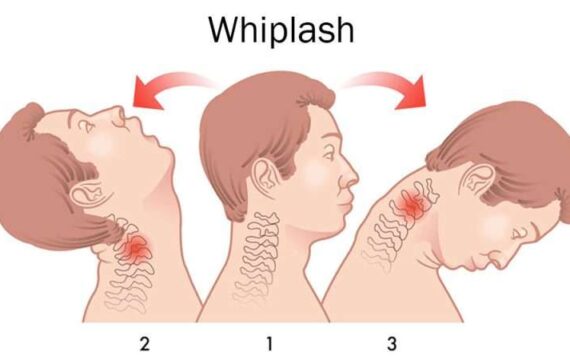 What Is the Fastest and Easiest Cure for Whiplash