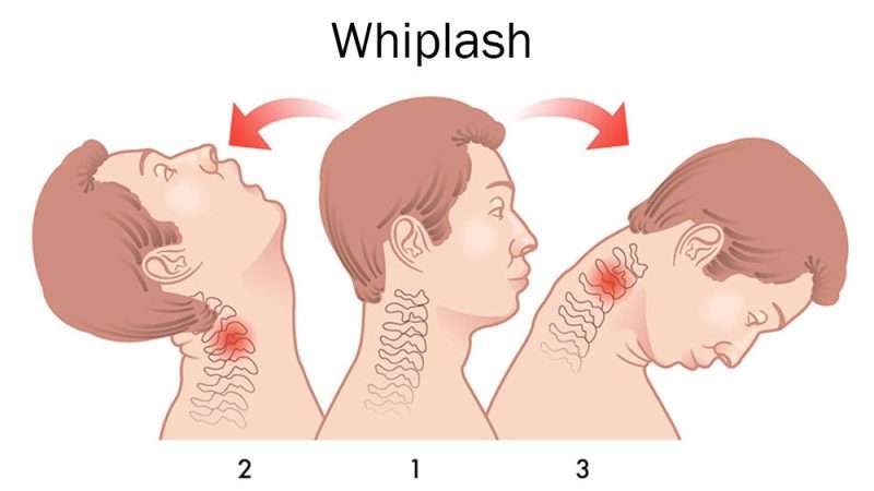 What Is the Fastest and Easiest Cure for Whiplash