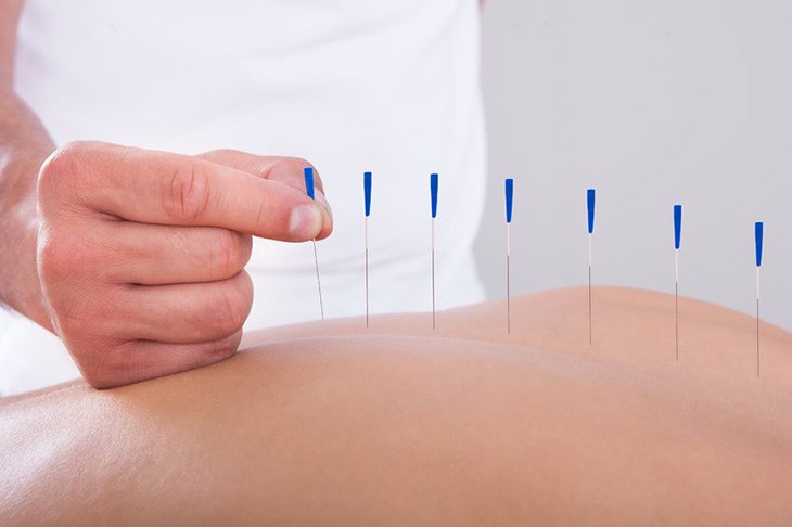 Dry Needling Treatment Houston