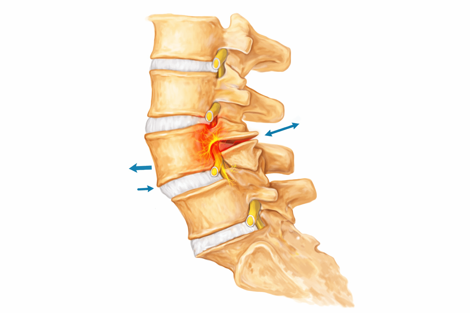 Spondylolisthesis