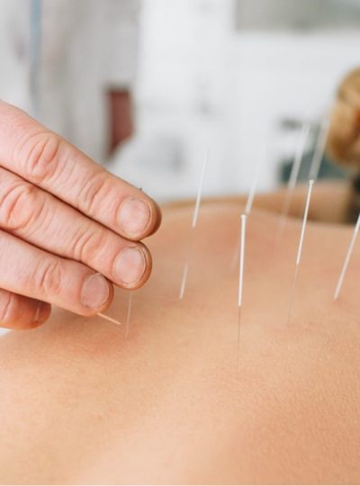 Dry-Needling